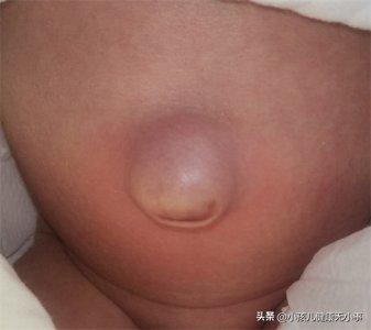 ​什么是脐疝？