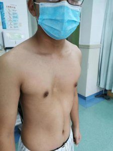 ​14岁少年胸部凹陷4年多，这是漏斗胸啊！这个细节不能忽视
