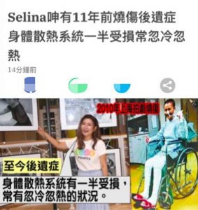 ​Selina再谈烧伤事故，自曝康复期像坐牢，体温至今冷热骤变