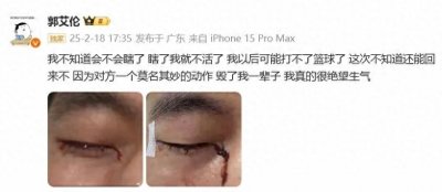 ​惊险一幕！郭艾伦眼睛被队友手指插伤，缝了40多针！