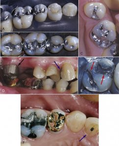 ​牙科医生讲义第十五讲：什么是嵌体