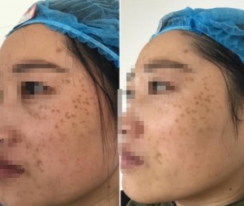 ​女子花12000元做祛斑，却惨遭“毁容”，商家：我继续给你修复