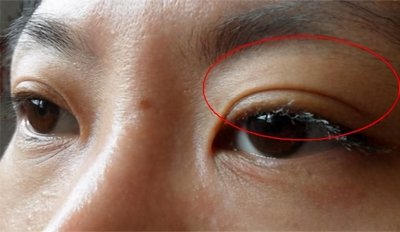 ​一个30岁的女性患者眼皮经常肿，来问是不是肾炎